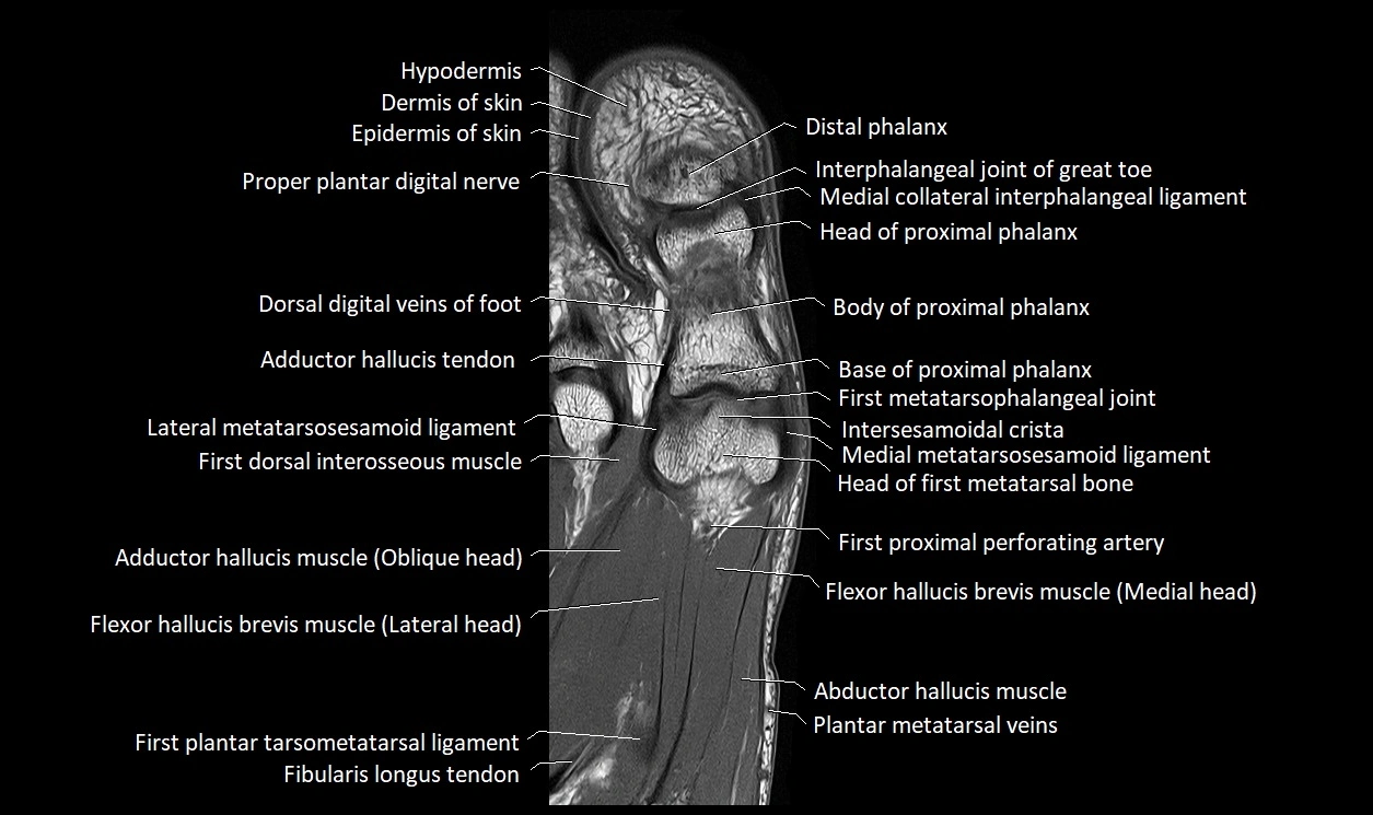 Great Toe micro anatomy MRI axial cross sectional 3T image 18.webp
